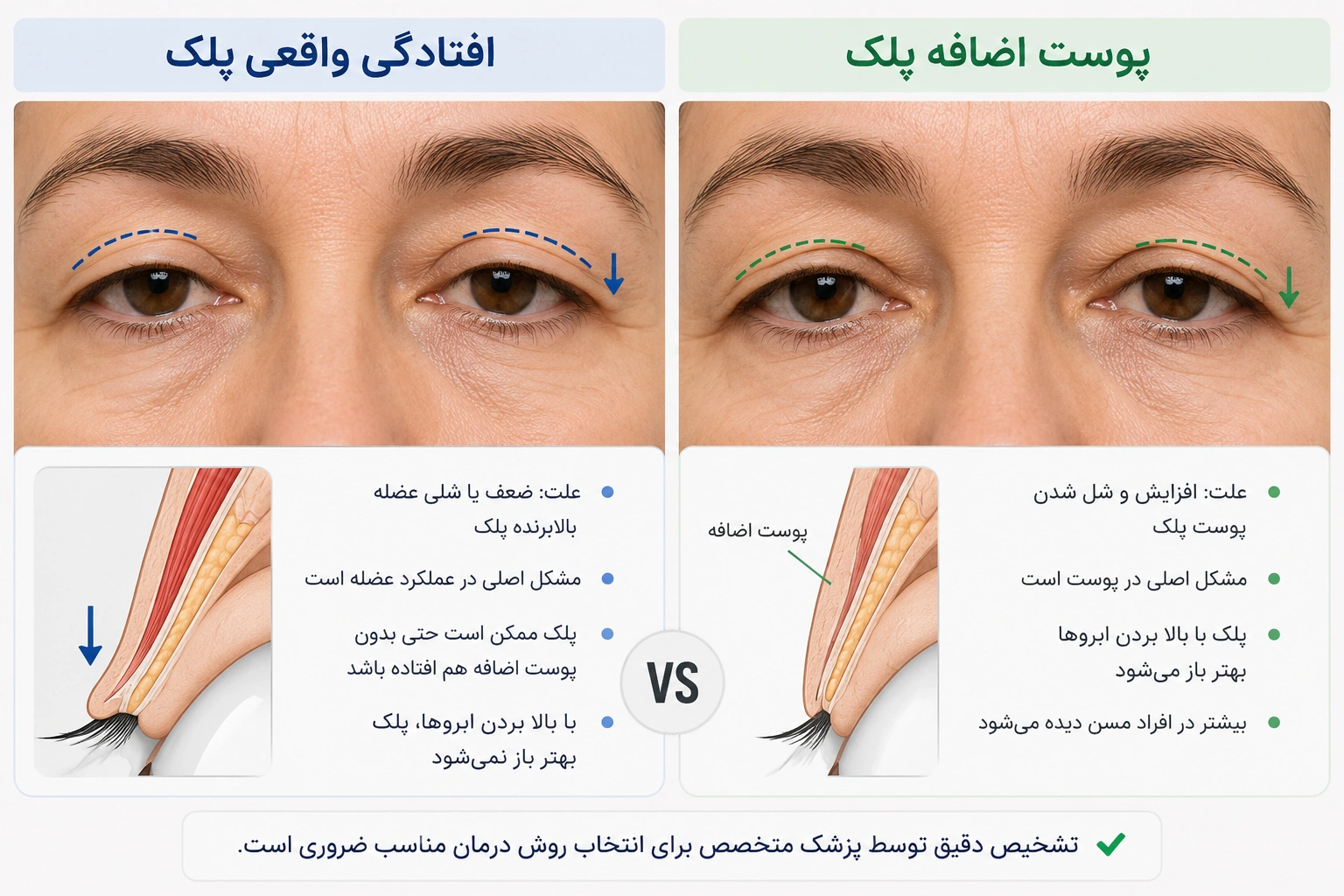 تفاوت افتادگی واقعی پلک با پوست اضافه چیست؟